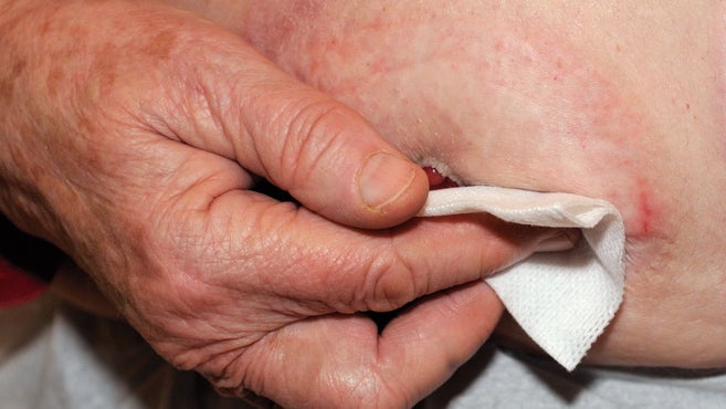 mão está a limpar o estoma