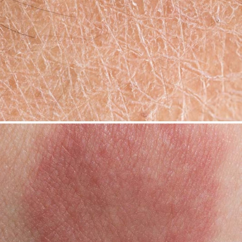 Pele seca e estrato córneo - Regulação da água corporal 