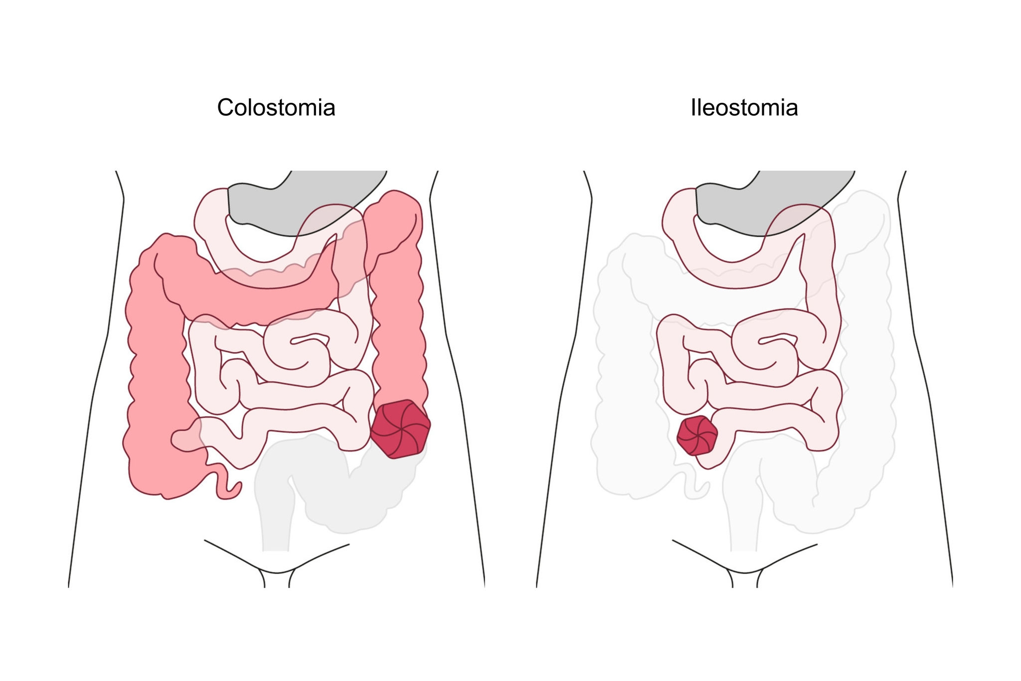 colostomia-Ileostomia