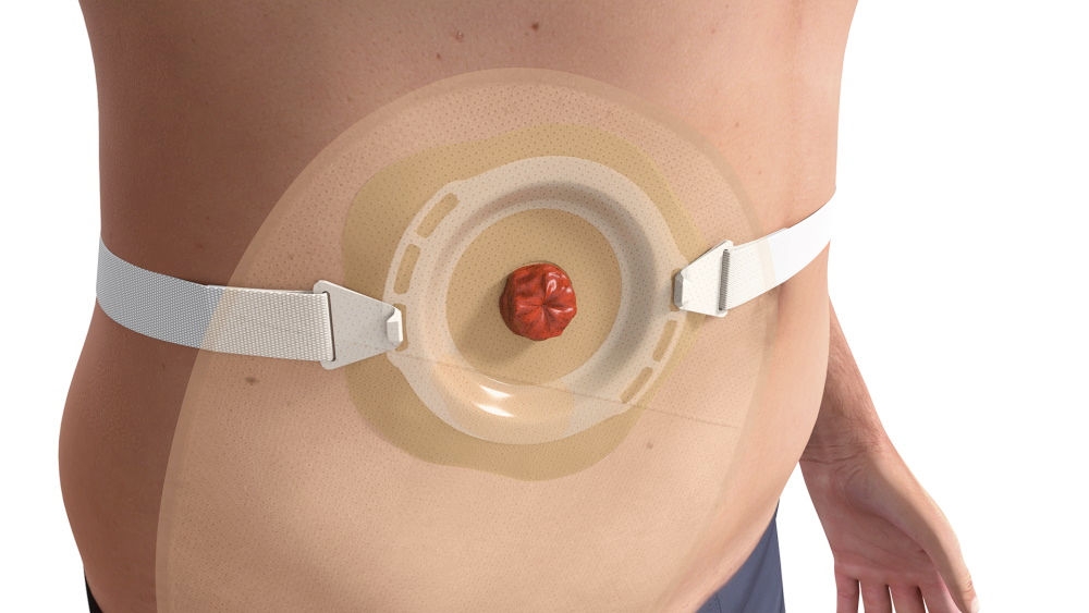 Ilustração de saco de ostomia convexo aplicado à volta de um estoma