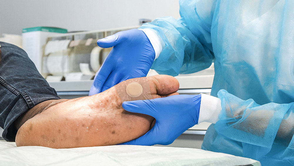 Duas mãos com luvas seguram um pé diabético com um penso, em segundo plano vê-se material médico de fundo numa sala clínica