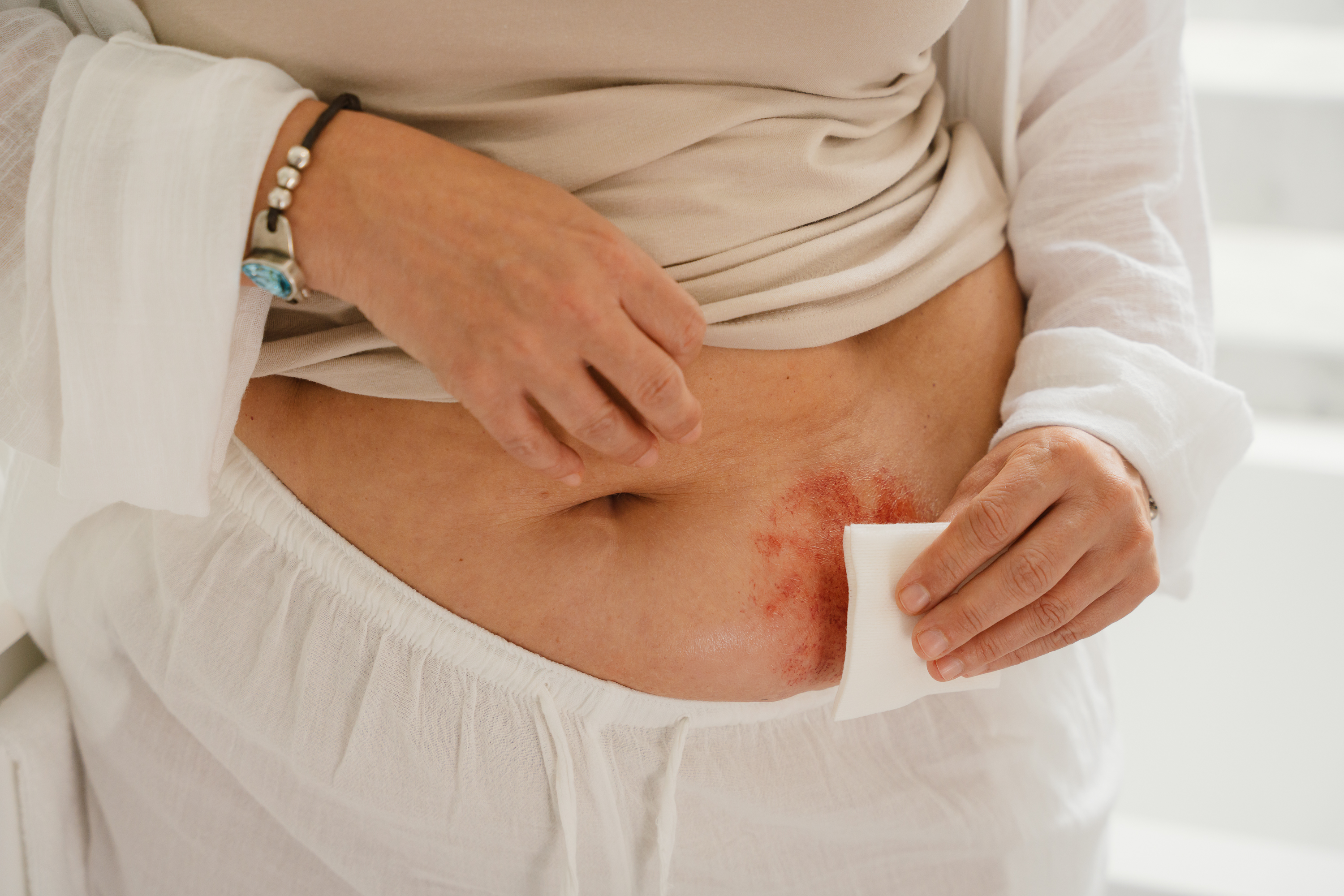 Um grande plano de uma pessoa com irritação cutânea vermelha à volta do estoma, utilizando uma gaze médica branca para limpar suavemente a pele peristomal no abdómen. A pessoa está a usar vestuário de cor clara e uma pulseira com esferas no pulso.