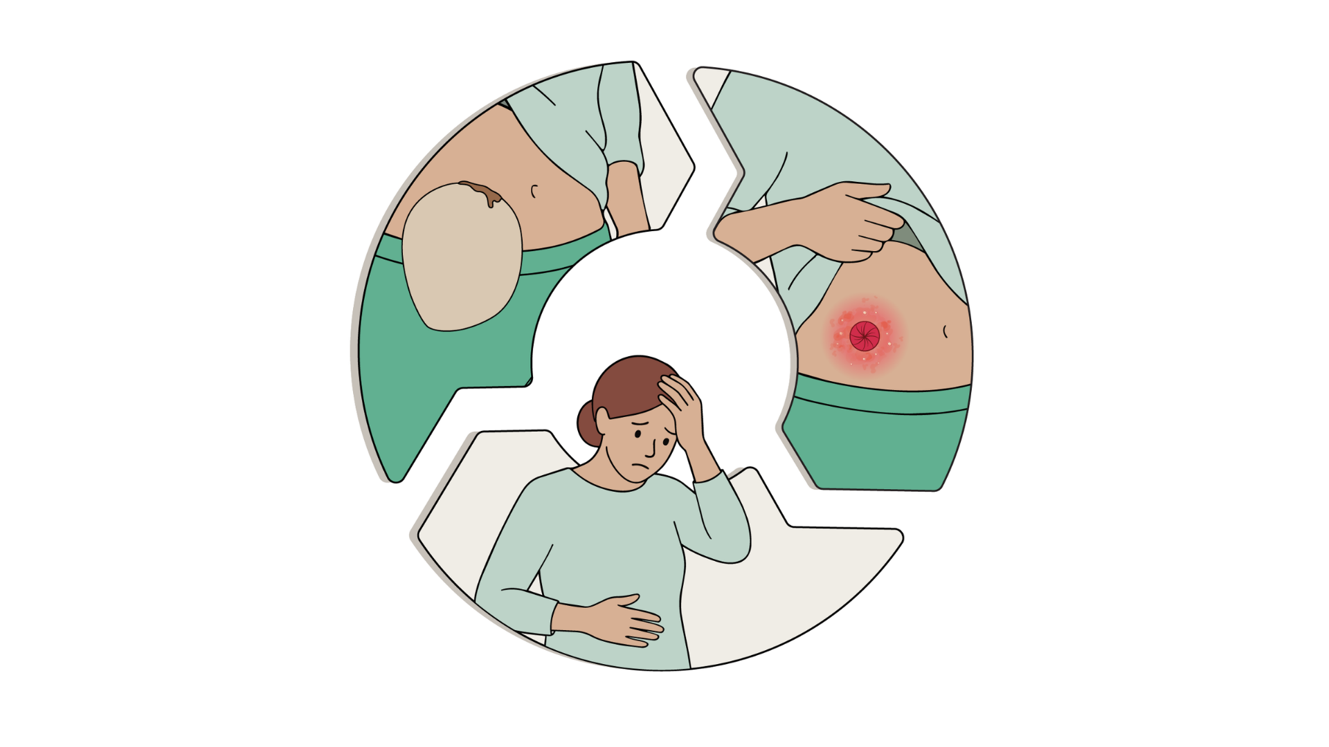 Uma ilustração de diagrama circular que mostra o ciclo das principais complicações da ostomia: "Fugas de ostomia" que resulta em "Irritação da pele à volta do estoma", o que resulta num "Impacto negativo na qualidade de vida", ilustrado por uma mulher em dificuldades.