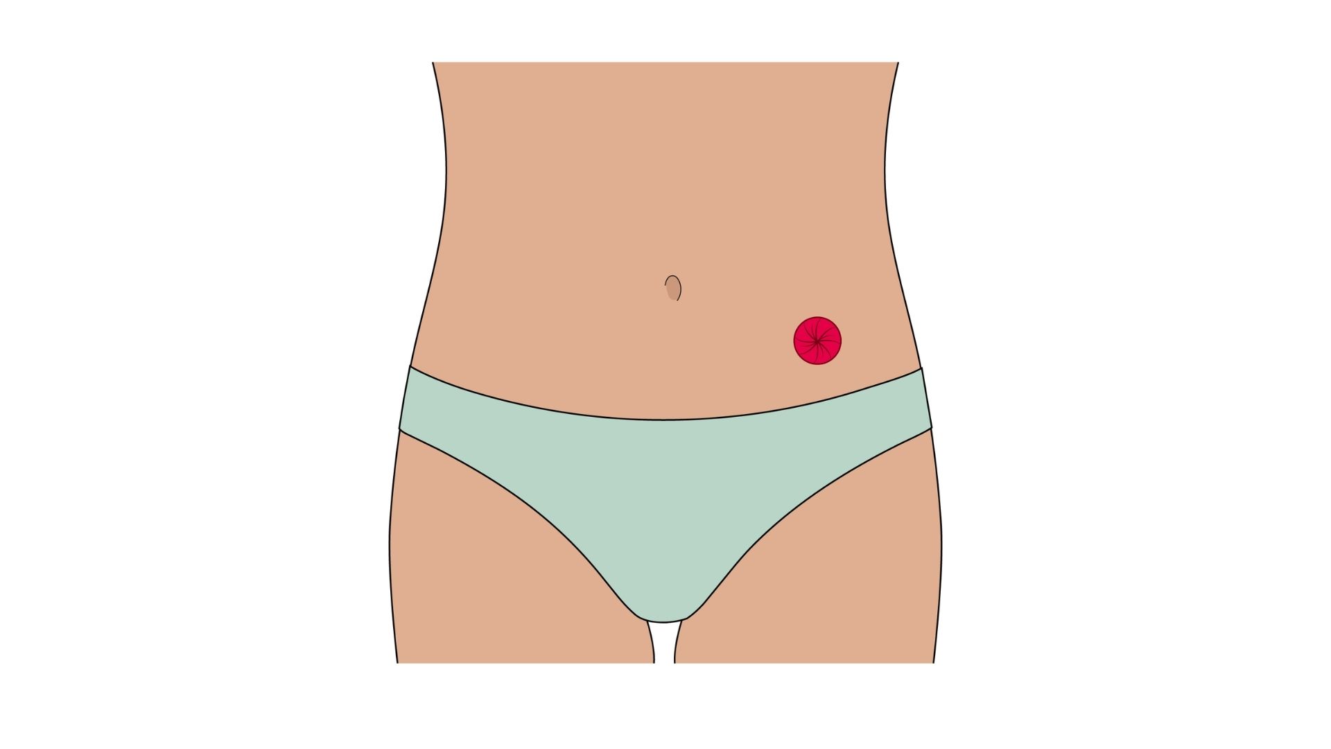  Uma ilustração anatómica que mostra a vista de uma colostomia, destacando como a estoma (representada a vermelho) liga o cólon descendente diretamente à parede abdominal, com a porção inferior do intestino desviada esbatida.