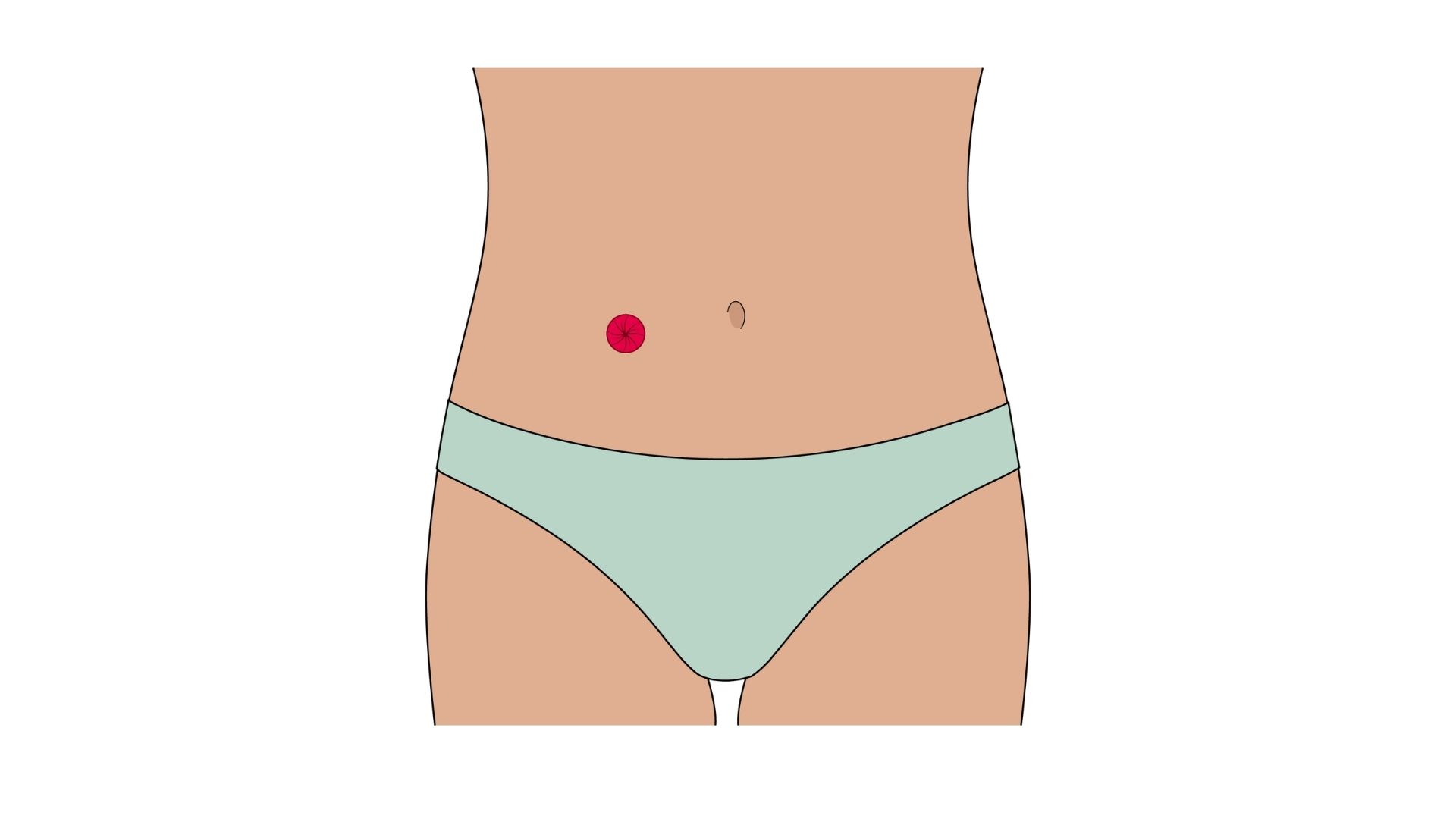  Uma ilustração anatómica que mostra a vista de uma ileostomia, destacando como a estoma (representada a vermelho) liga o intestino delgado (íleo) diretamente à parede abdominal, com todo o intestino grosso esbatido.