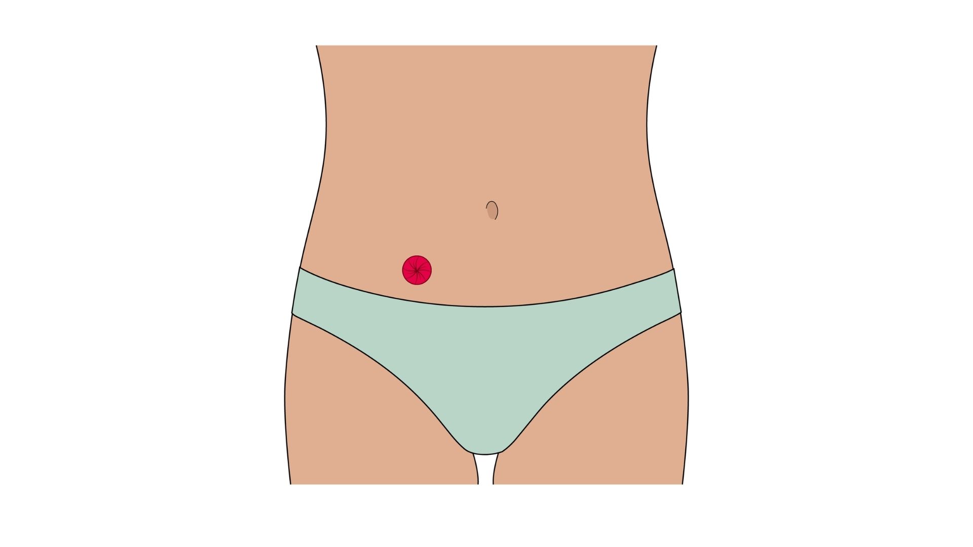 Uma ilustração anatómica que mostra a vista de uma urostomia, destacando os dois rins e ureteres ligados a um segmento isolado do intestino (conduto ileal) que cria o estoma, representado a vermelho na parede abdominal, com o trato digestivo esbatido.
